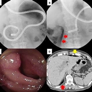 This is a case of micro-intestinal perforation during biliary ...