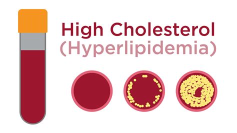 High Cholesterol: Mild Issues That Might Be The Symptoms Of It, Check Out - Stackumbrella.com