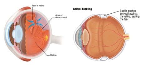 Retinal Detachment Treatment Bronx | Scleral Buckle Procedure NY