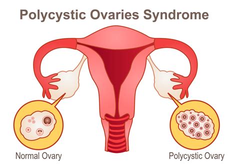 Learn All about Polycystic Ovary Syndrome - Exploring your mind