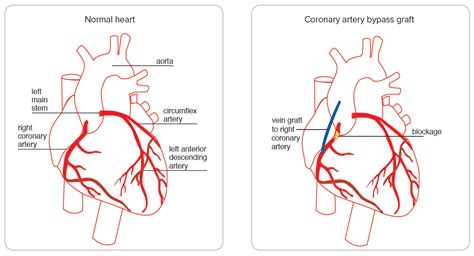 Coronary artery bypass graft surgery - Heart Foundation