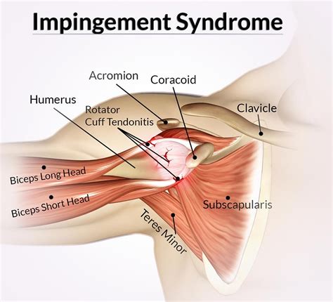 Shoulder Impingement Syndrome | Local Physio