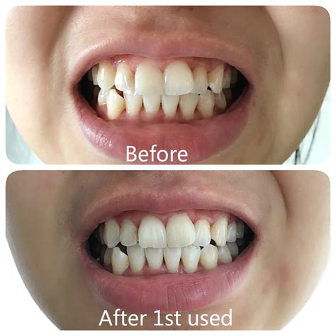 Pop Smile Teeth Whitening Home Kit review ( Before & After ) - Travel & Lifestyle Charlene22