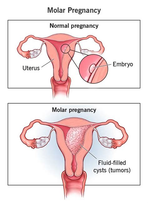 Hydatidiform mole meaning, causes, signs, symptoms, diagnosis & treatment