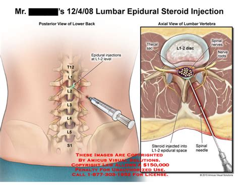 Lumbar Epidural Steroid Injection