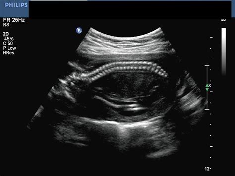 Doctors Gates: 2-D & 3-D Ultrasound images of normal fetal spine