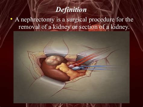 Nephrectomy