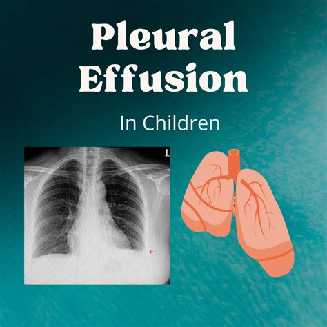 Pleural effusion or Fluid inside the chest in children: causes, diagnosis & treatment!! - Dr ...