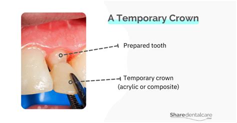 Temporary Crown Broke Off: Causes & What to Do? - Share Dental Care