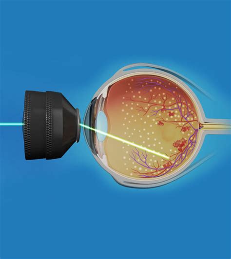 Laser Eye Surgery Services New York | Manhattan Retina and Eye