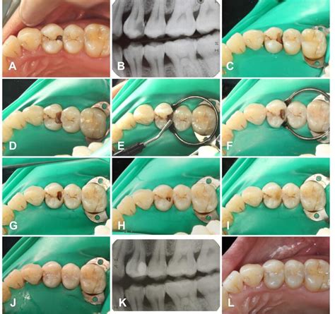 Steps of restoration in Tooth 24. (A) Preoperative image of 24; (B ...