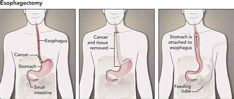 Mckeown Procedure : Modified McKeown procedure with uniportal ...