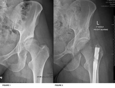 Derotational Femoral Osteotomy (DFO) - CU Sports Med Hip Clinic