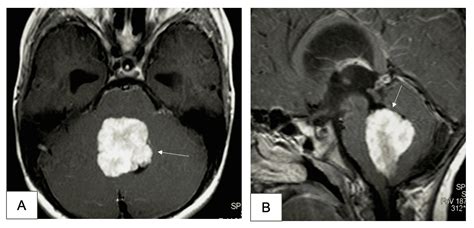 Cureus | Choroid Plexus Papilloma of the Fourth Ventricle in a Pediatric Patient: A Case Report