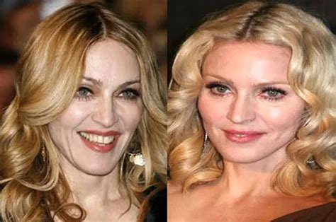 Madonna Facelift Plastic Surgery Before and After | Celebie