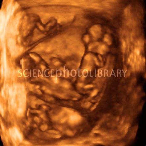 12 week quadruplets, 4-D ultrasound scan - Stock Image P680/0644 | Quadruplets, Ultrasound ...