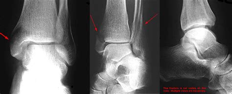 Bimalleolar fracture