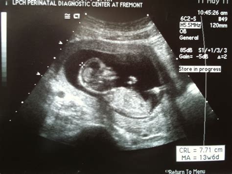 Athena's Chateau: 2nd Nuchal Translucency Ultrasound, 5/11/2011