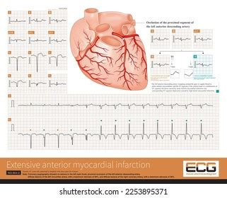 Occlusion Proximal Left Anterior Descending Artery Stock Illustration ...