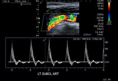 Pin on Vascular ultrasound