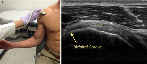 Rotator Cuff Tear Ultrasound