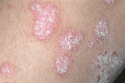 Stress as an Influencing Factor in Psoriasis