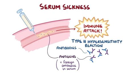 Video: Serum sickness