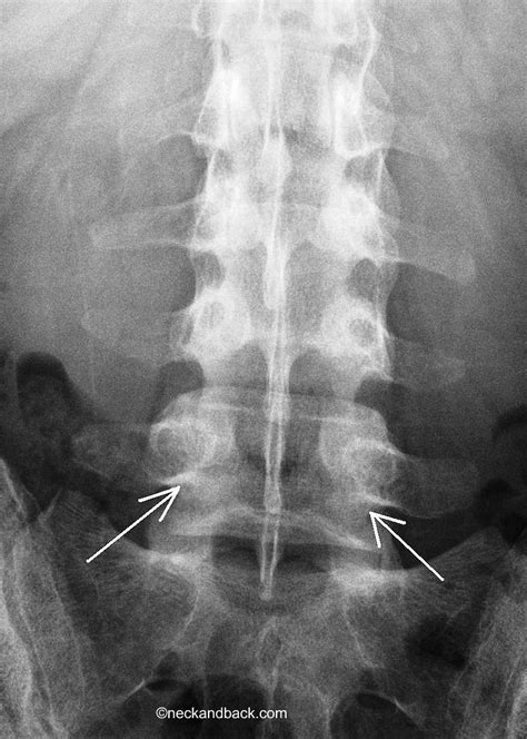 Pars Fracture | X-Ray of a Pars Interarticularis | Fractur… | Flickr