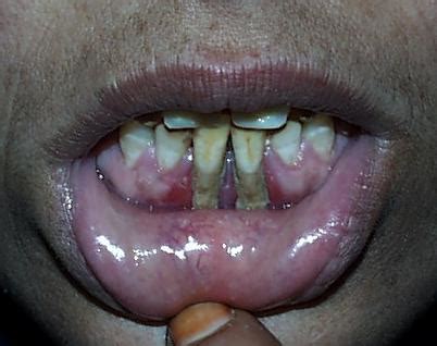 MEDICAL PHOTOGRAPHY AND VIDEOS, MEDICAL PHOTOGRAPHY: TOOTH DISEASE PHOTOS, TEETH PROBLEMS, TEETH ...