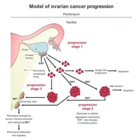 (PDF) Anti- Metastatic Gene Therapy in Patients with Advanced ...