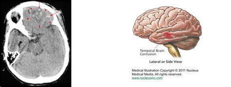 Anatomy Page - Cerebral cONTUSION