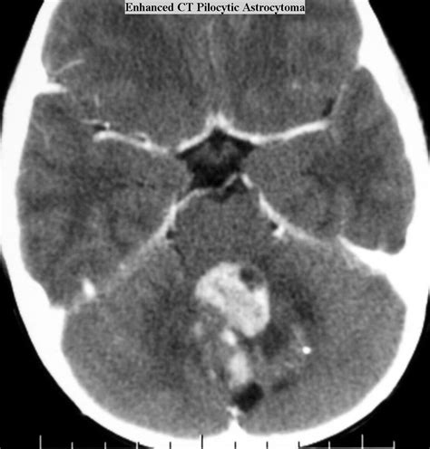 Glioma: Juvenile Pilocytic Astrocytoma Glioma