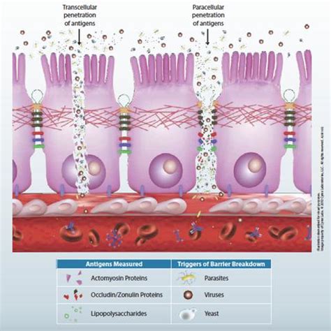 Could Leaky Gut Be A Factor In Your Autoimmune Disease? - Doctor Auer