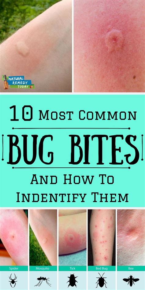 #bugbites #commonbugbites bug bites + most common bug bites + mosquito bites + dangerous bug ...