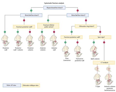 Classification of Acetabulum Fractures | Musculoskeletal Key