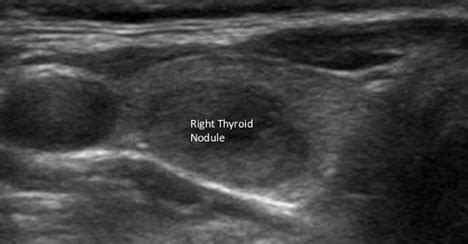 Normal Thyroid Ultrasound