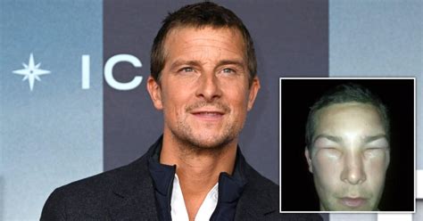 Bear Grylls shows horror swollen face after near-deadly bee sting ...