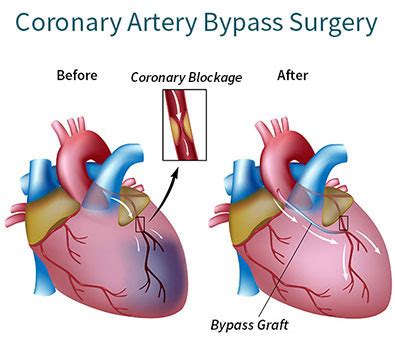 Open Heart Surgery: Risks, Procedure & Preparation