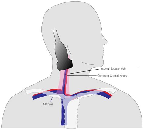 Ultrasound-Guided Central Line Placement Made Easy: Step-By-Step Guide