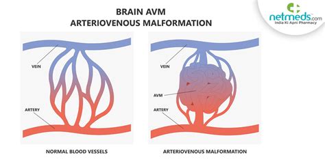 Arteriovenous Malformation