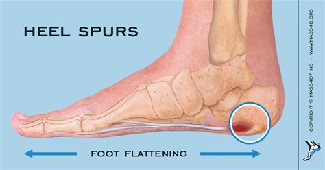 Heel Pain – Causes and Treatment | MASS4D® Insoles - MASS4D® Foot Orthotics