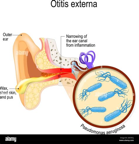 Swimmer's ear. Otitis externa is inflammation of the ear canal. bacterial infections disease ...