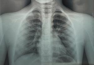 Chest X-rays not reliable in diagnosing COVID-19 respiratory infections - ECS International