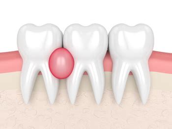 Tooth Abscess Drainage | Emergency Dentist Adelaide