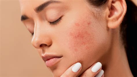 Beauty tips: How to manage dry skin with acne | HealthShots