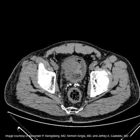 Blood In Urine Prostate Cancer Survivor