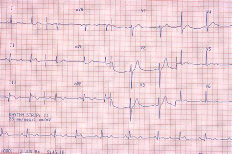 Wenckebach Ekg