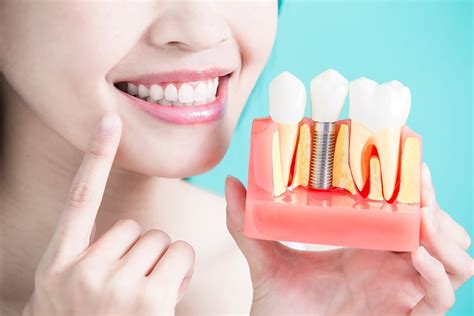 What are Dental Implants? - Types of Dental Implants