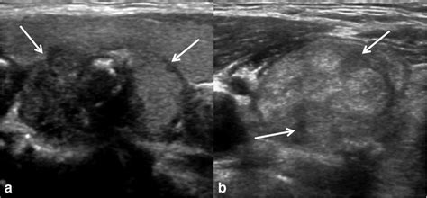 Thyroid nodules with heterogeneous echotexture. a Nodule with ...