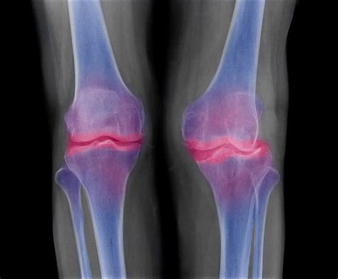 What Is Anterior Osteophytic Lipping | Sitelip.org